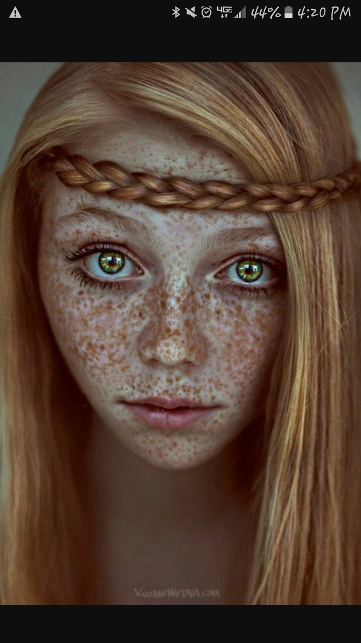 Freckles