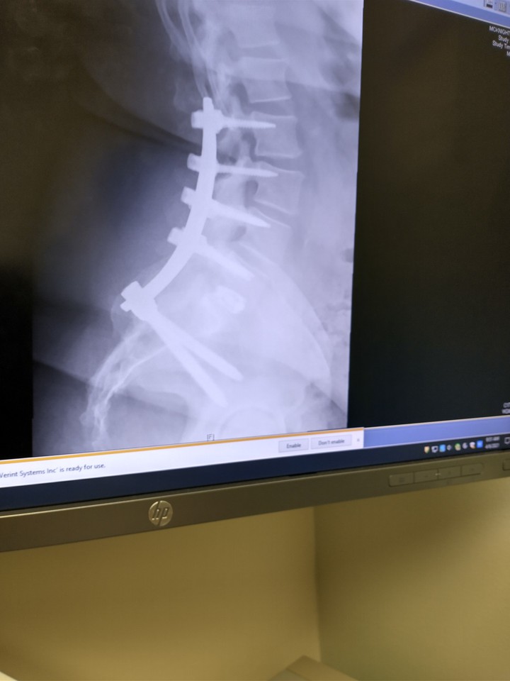 Spine_Fusion