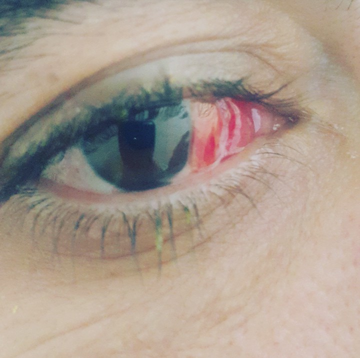 eye