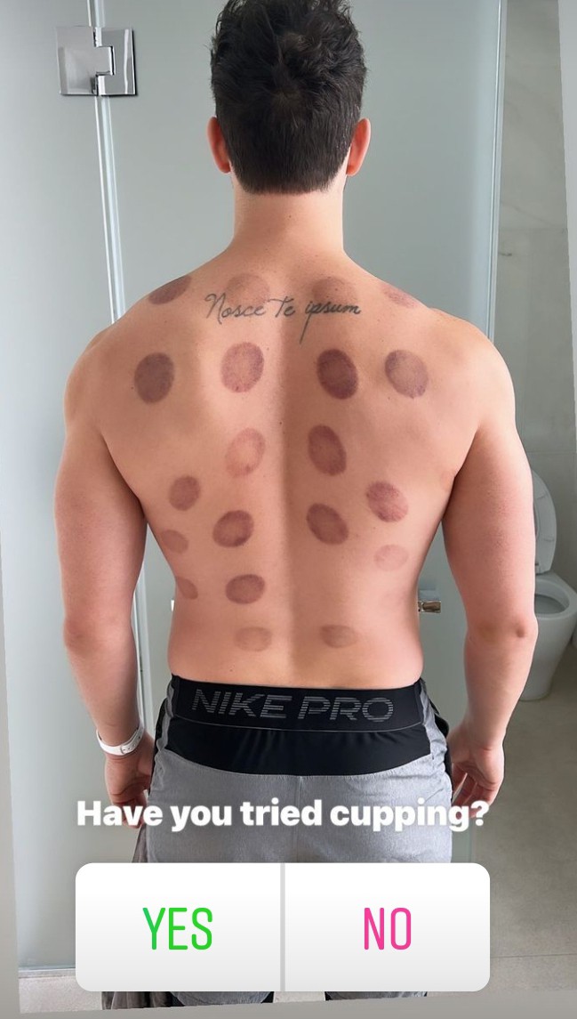 Have you tired cupping