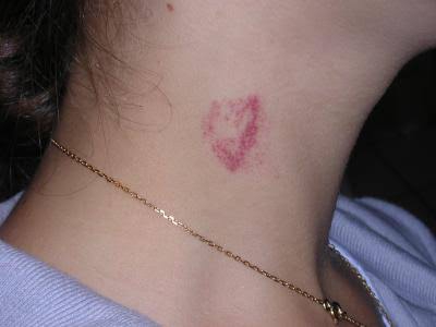 Kiss
