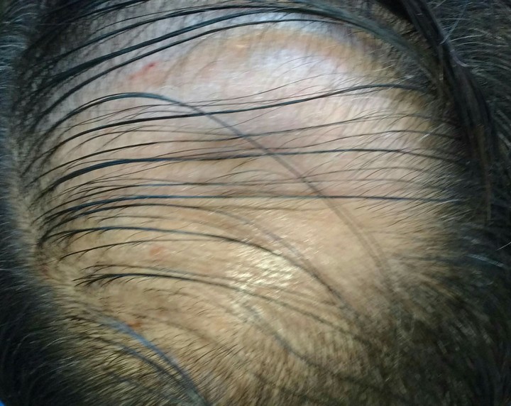 balding head