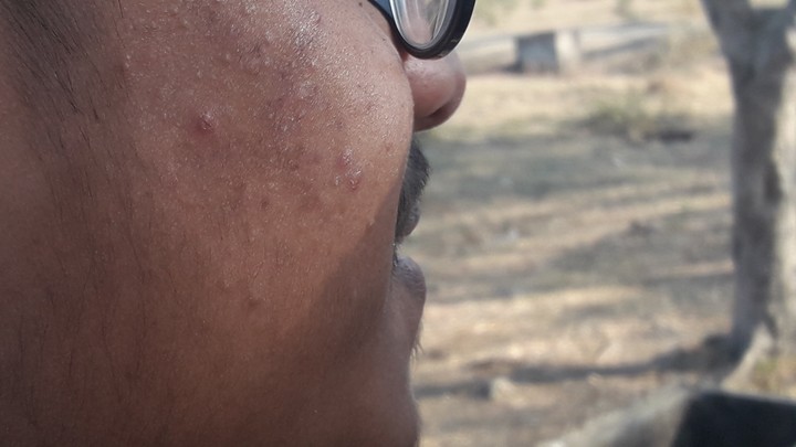 See His Pimples.....