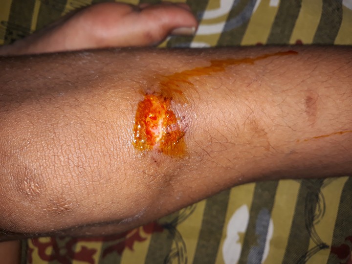 OMG.. WHAT THE HELL????  Under the knee was Blooding