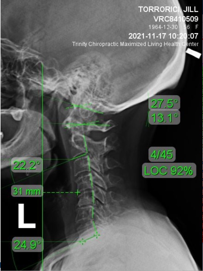 xray