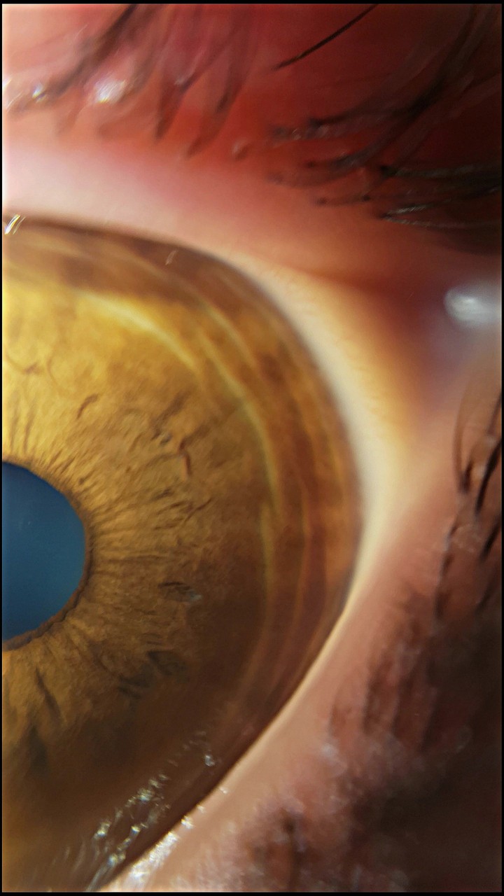 my eye