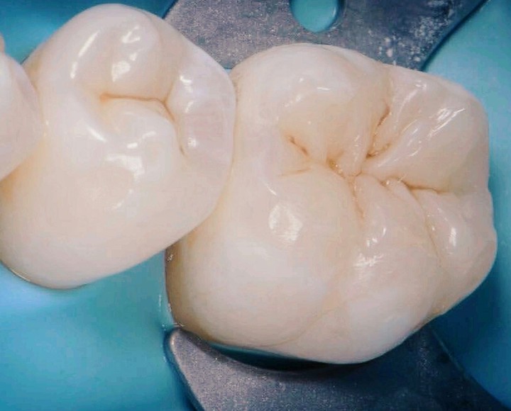 tooth