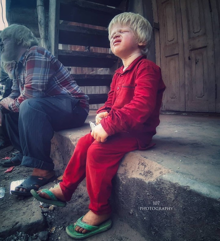 Albino Kid