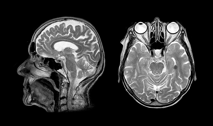 MRI