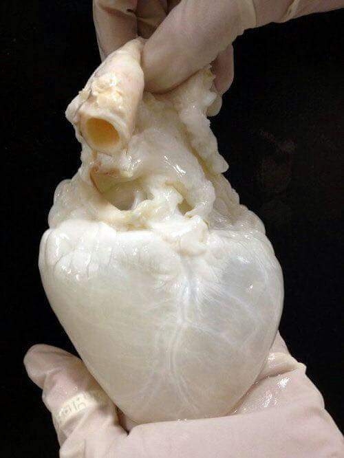 heart without blood