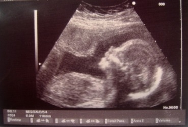 fetus