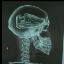 x ray for some people 