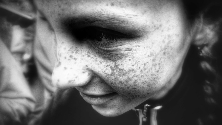 girl with spots on her face