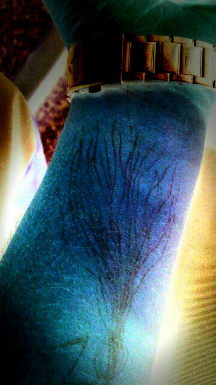 tree on arm