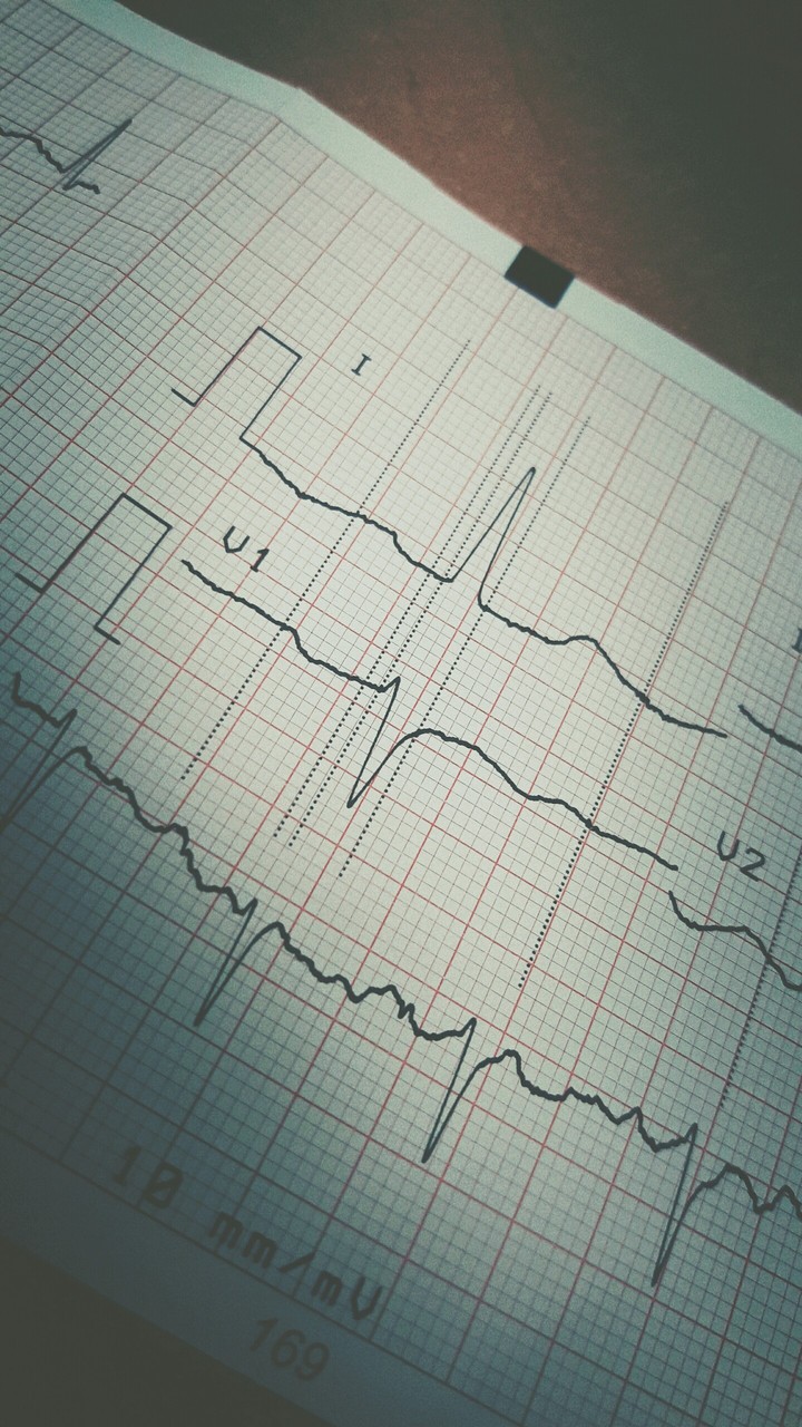 EKG